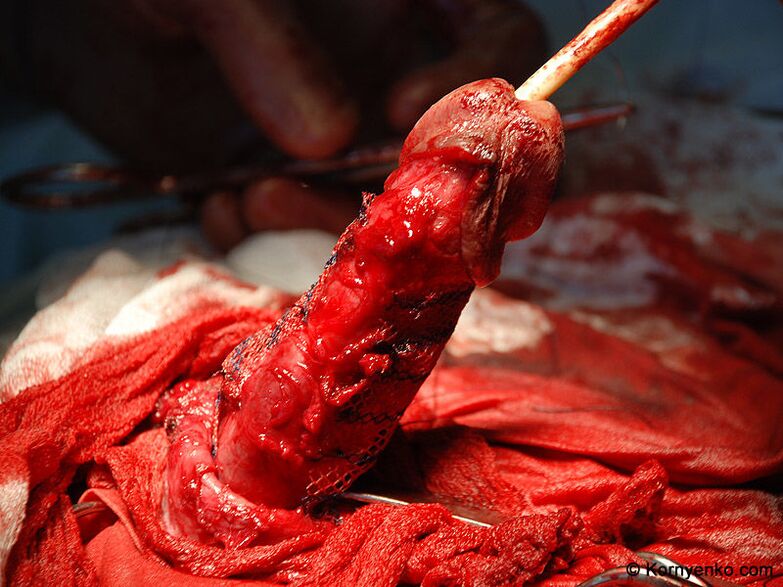 zakila handitzeko kolageno matrizea instalatzea