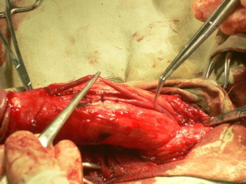 zakila handitzeko kirurgia egitea