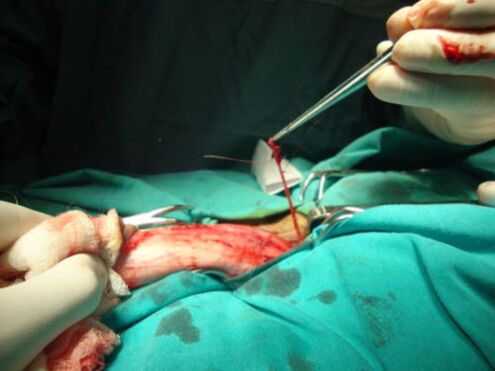 zakila handitzeko kirurgia