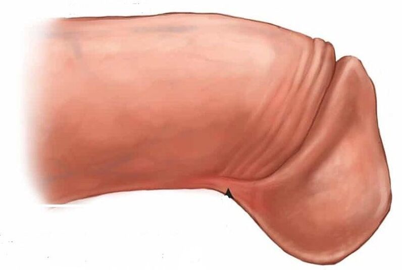 nola handitu glande zakila